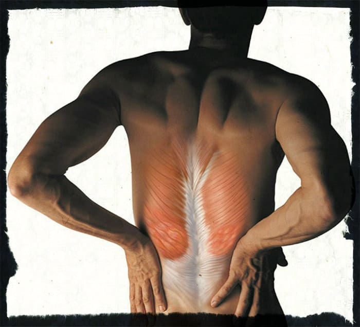 Растяжение мышц спины: симптомы, лечение в домашних условиях