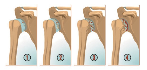Стадии артроза плечевого сустава