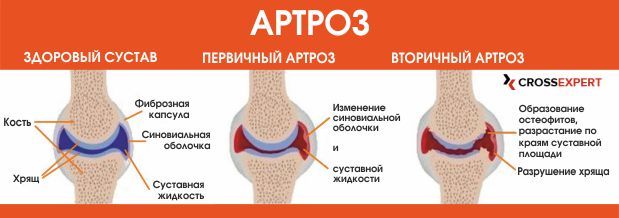 артроз - виды и стадии