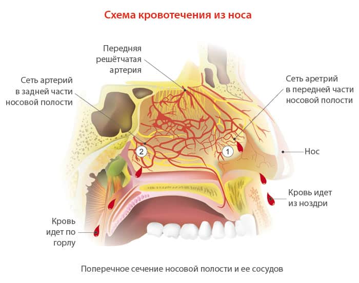 Схема кровотечения из носа